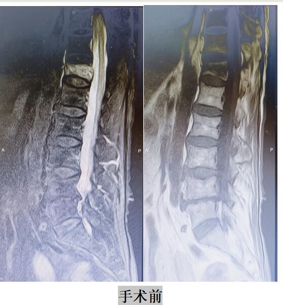 91岁杨某腰部疼痛致不能行走，年迈老人还能康复吗？