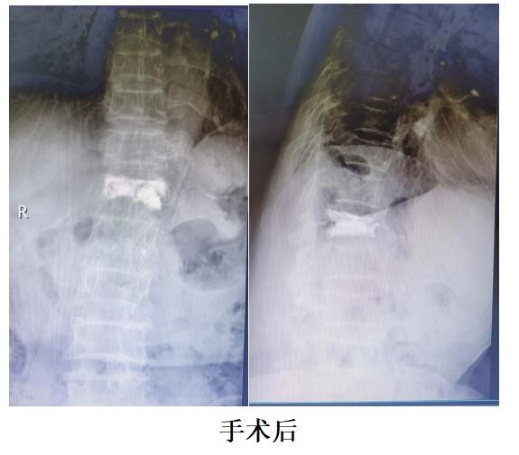 91岁杨某腰部疼痛致不能行走，年迈老人还能康复吗？